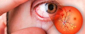 O que é retinopatia diabética? Existe tratamento? | Centro Oftalmológico de Guarapuava