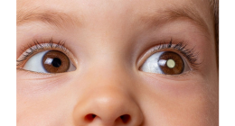 RETINOBLASTOMA: O PERIGO INVISÍVEL QUE PODE AMEAÇAR A VISÃO INFANTIL | Centro Oftalmológico Guarapuava