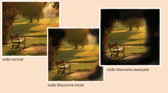 Cirugia Glaucoma | Centro Oftalmológico Guarapuava